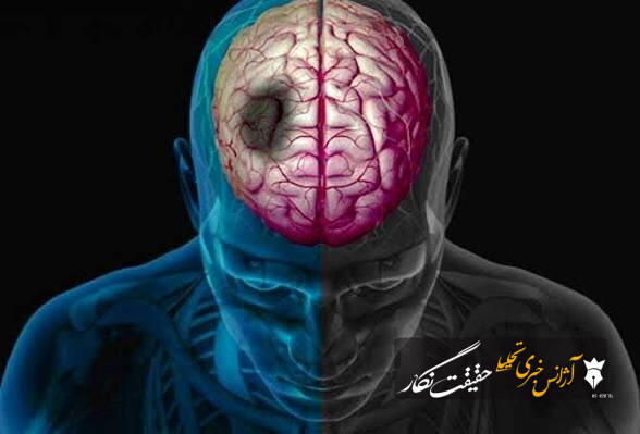 یک متخصص: هر دقیقه تأخیر در درمان سکته مغزی به نابودی ۱.۹ میلیون سلول عصبی منجر میشود یک متخصص: هر دقیقه تأخیر در درمان سکته مغزی به نابودی ۱.۹ میلیون سلول عصبی منجر میشود