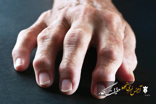 رابطه عجیب میکروب‌های دهان با آرتروز دست!