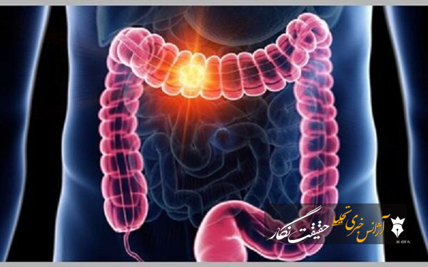 ضرورت آغاز غربالگری سرطان روده بزرگ در کشور از ۴۵ سالگی/افزایش ۵۰ درصدی ابتلا طی یک دهه